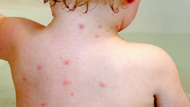 الطفح الجلدي يمكن ان يكون إشارة باصابة ابنك بكوفيد19