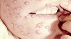 تسجيل أول حالة إصابة بمرض المانكبوكس أو جدري القردة بالمغرب.