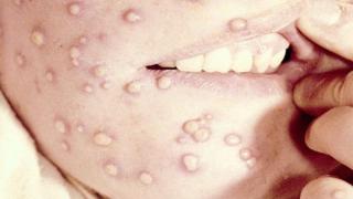 تسجيل عشرات الإصابات بمرض “جدري القرود” بإسبانيا والبرتغال.. والمرض يقترب من المغرب