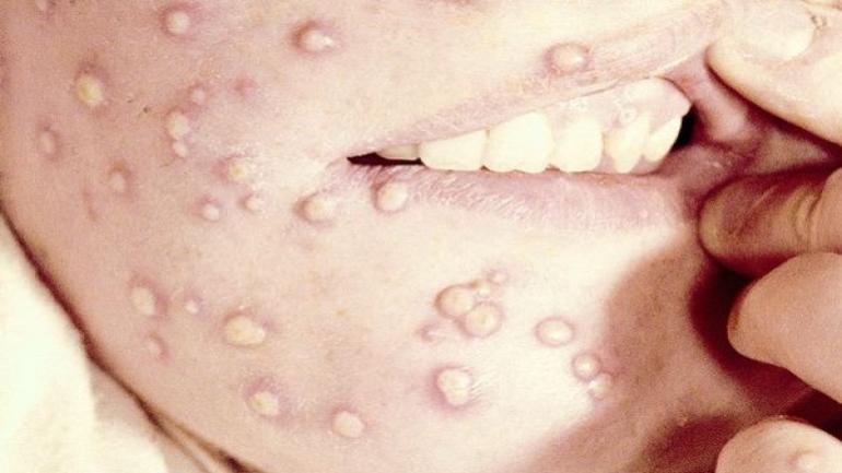 وزارة الصحة والحماية الاجتماعية تعلن عن تسجيل حالة إصابة مؤكدة بفيروس جذري القردة (المانكبوكس) بالمغرب