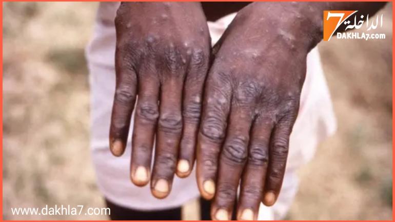 وزارة الصحة تطمئن المواطنين بمستوى اليقظة والاستعداد لفاشية جدري القردة “إم-بوكس”